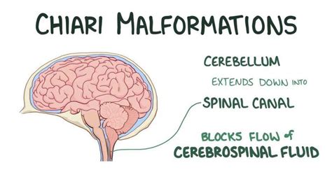 Arnold Chiari Malformation Medizzy