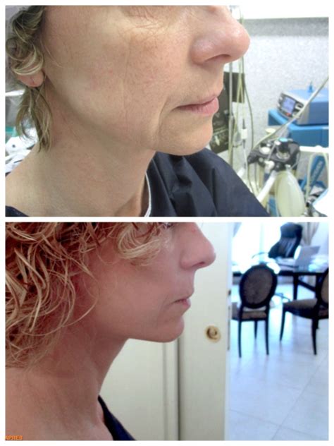 Lifting Du Visage Et Du Cou Cervico Facial