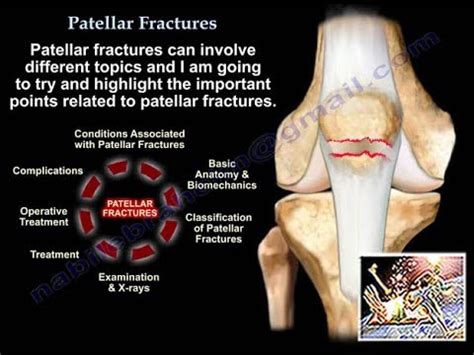 Patella Fracture Classification