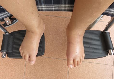 Edema, Swelling in Legs from Obesity vs. Heart Failure » Scary Symptoms