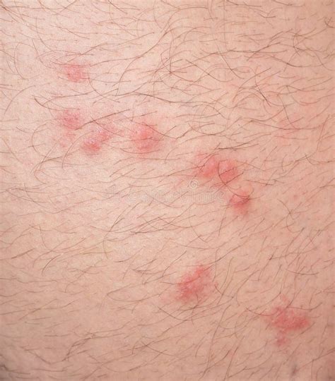 Flea Bites Over Caucasian Man Hairy Skin Stock Photo - Image of irritated, background: 45511358