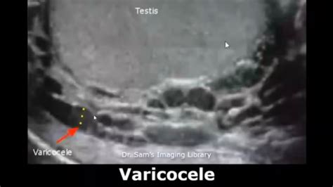 Varicocele Ultrasound Interesting Case In 34 Years Old Patient With Hx Of Secondary Infertility