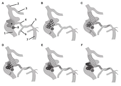 Schematic Illustration Of Coil Embolization In The Present Case