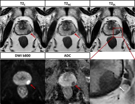 Deep Learning Super Resolution Reconstruction For Fast And Motion