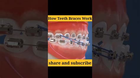 How Braces Work Dental Animation Bodyinsight New Youtube