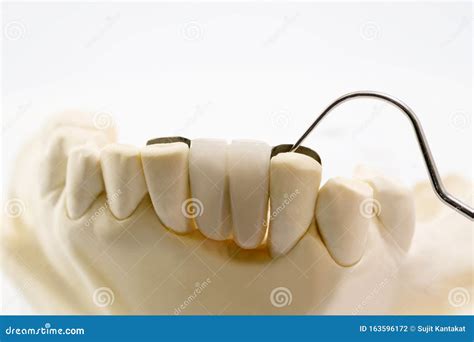 Dental Maryland Bridge Stock Image 194913739