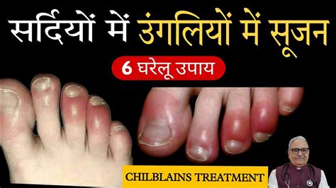 ठंड में पैरों की उंगलियों में सूजन खुजली आने पर क्या करेंfinger Swelling In Winter Sehat Ki