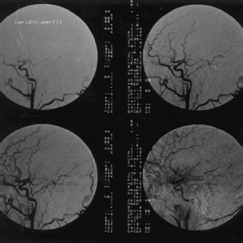 Intra Arterial Angiography Of The Left ICA Showing Severe Stenosis With