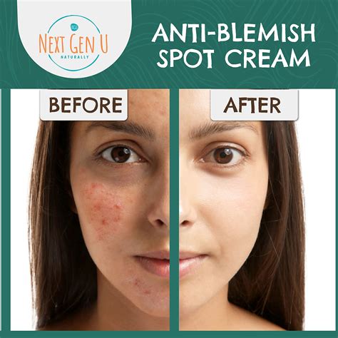 Anti Blemish Spot Cream 100ml Helps Reduce Blackheads And Blemishes