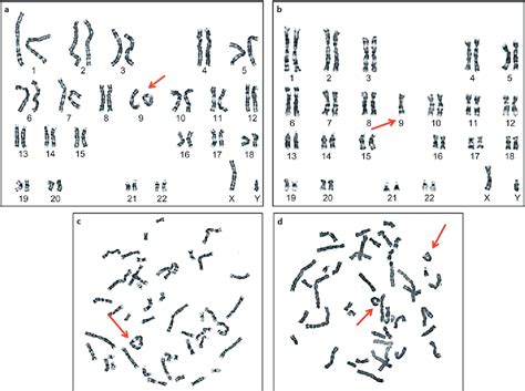 A Comprehensive And Clinical Review Of Chromosome 9 Ring Syndrome