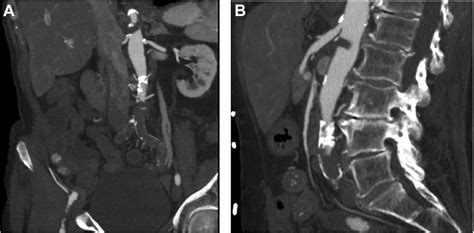 Hybrid Repair For Acute Aortic Occlusion Using Aortobifemoral Bypass And Angiovac Thrombectomy