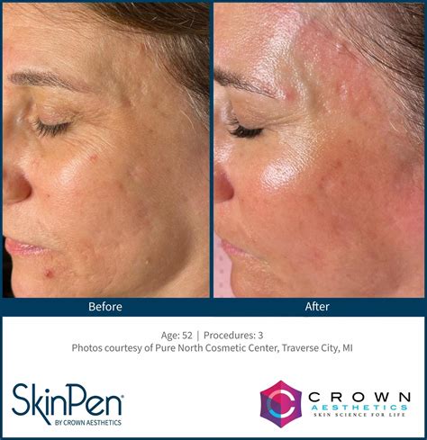 Microneedling Ann Arbor Mi Ganger Dermatology