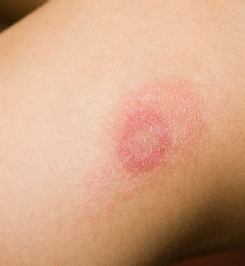 Fungal Infection/Ringworm - Richmond Dermatology