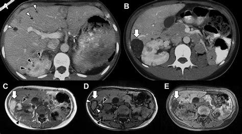 Fat Containing Lesions Of The Liver A Review Of Differential Diagnoses