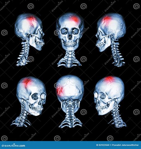 Cervical Fracture And Human Spine And Vertebrae Damage Outline Diagram