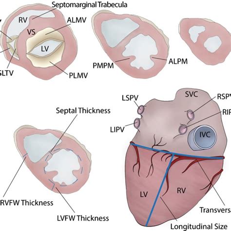 Normal Heart Vs Cardiac Hypertrophy A Cross Section Of A Normal Heart