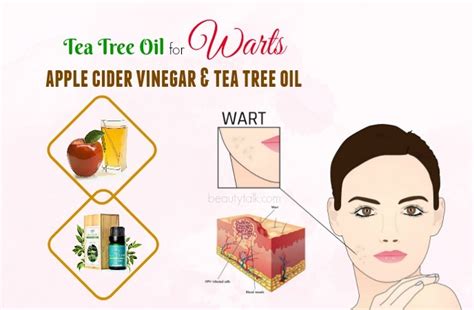 17 Simplest Ways To Use Tea Tree Oil For Warts Removal