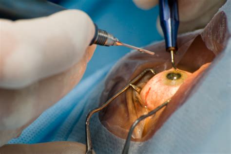 Procedure For Cataract Surgery From Beginning