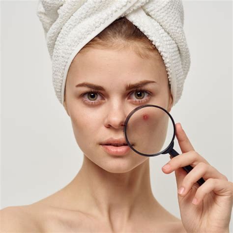 How To Get Rid Of Acne Scars Goodieco Australia