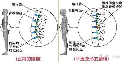 论中医正骨为什么能快速治愈腰间盘突出症 知乎