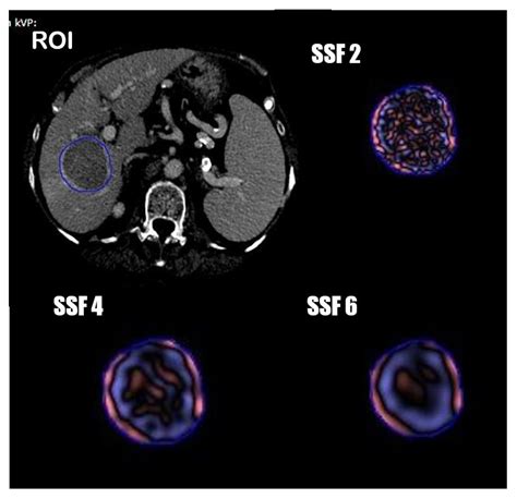 Diagnostics Free Full Text Hepatocellular Carcinoma Drug Eluting