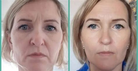 Hifu Nonsurgical Facelift Skin Tightening And Repair