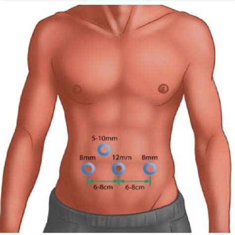 Peritoneal Flap Creation The Incision Should Be Done Right Above Download Scientific Diagram