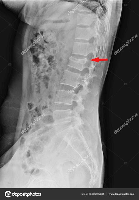 Lumbar Spine Compression Fracture Of L2 — Stock Photo © Richmanphoto