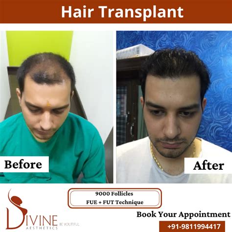 Affordable Cost Of Hair Loss In India Save Hair Loss