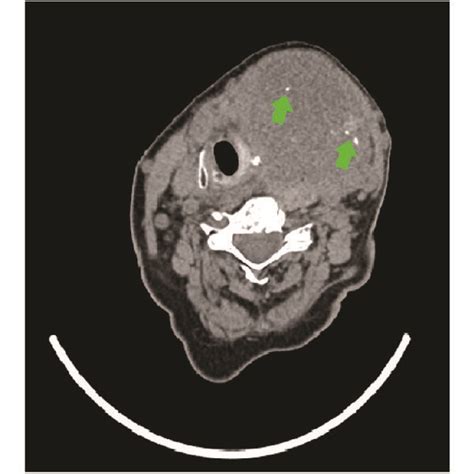 Significantly Enlarged Thyroid Mass Causing Tracheal Deviation To The Download Scientific