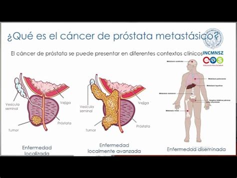 Enfermedad Metastásica por Cáncer de Próstata INCMNSZ Educación