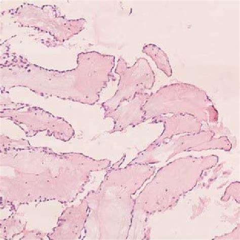 The Papillary Tumor With Hyalinized Collagenous Matrix Encountered By