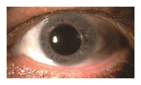 A Color Anterior Segment Picture Of The Right Eye With A Quiet