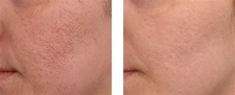 Dermapen Penwortham Skin And Laser Clinic