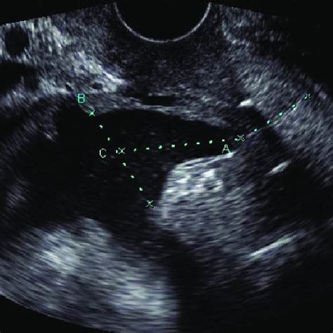 Cervical measurement obtained after cerclage placement. (A) total ...