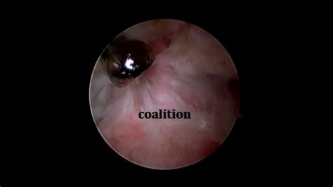 Endoscopic Resection Of A Talocalcaneal Coalition Using A Posteromedial