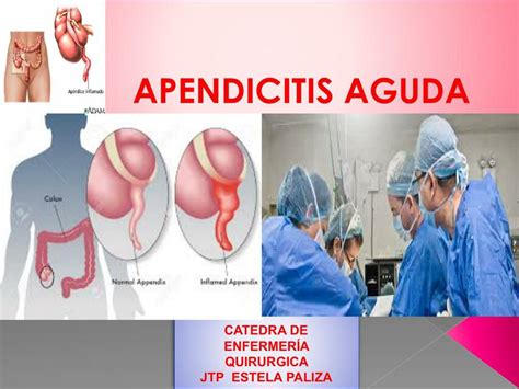 Apendicitis Aguda Daniela Villagra Udocz