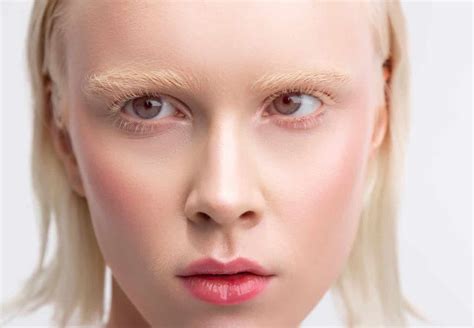 Ocular Albinism: Symptoms and Treatment | Área Oftalmológica