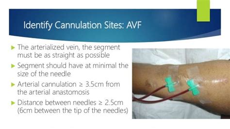 3 Types Of Vascular Access Ports Used In Hemodialysis