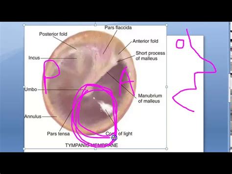 Malleus Tympanic Membrane