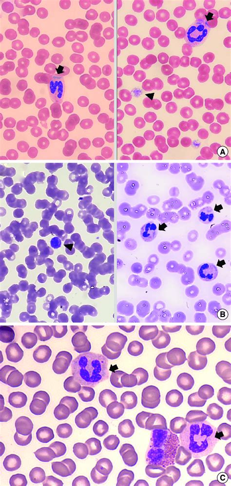 Peripheral Blood Smears 1 000 Wright Giemsa Stain Of A Proband 1