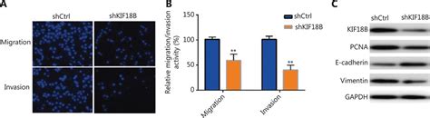 Kif B Promotes Tumor Progression In Osteosarcoma By Activating