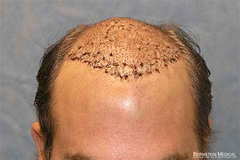 Patient Bib Bernstein Medical Center For Hair Restoration