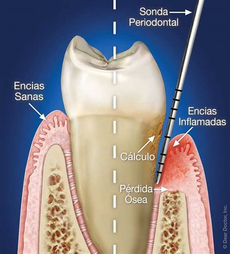 Enfermedad De Las Encías