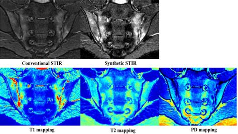 Frontiers Synthetic Mri In The Detection And Quantitative Evaluation