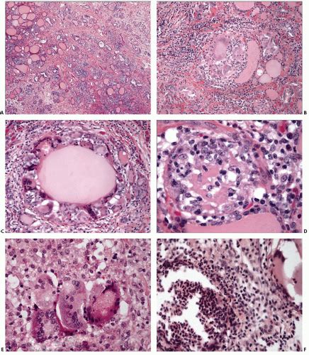 Thyroiditis Basicmedical Key