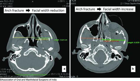 5 Change in facial dimension in zygomatic arch fractures. (a) Inward... | Download Scientific ...