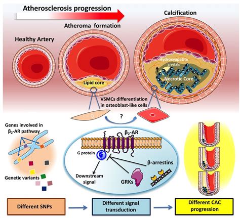 β2 AR signaling and CAC progression impact on genetic risk Coronary