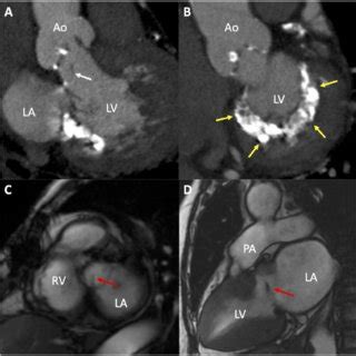 Imaging Of The Cardiac Mass A And B Contrast Computed Tomography