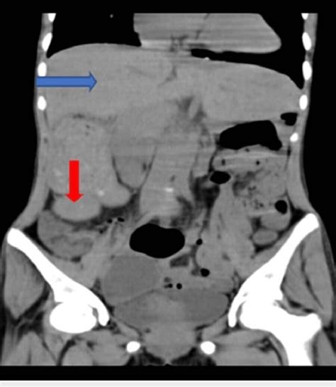 The Blue Arrow Showing The Central Large Liver Extending From The Right
